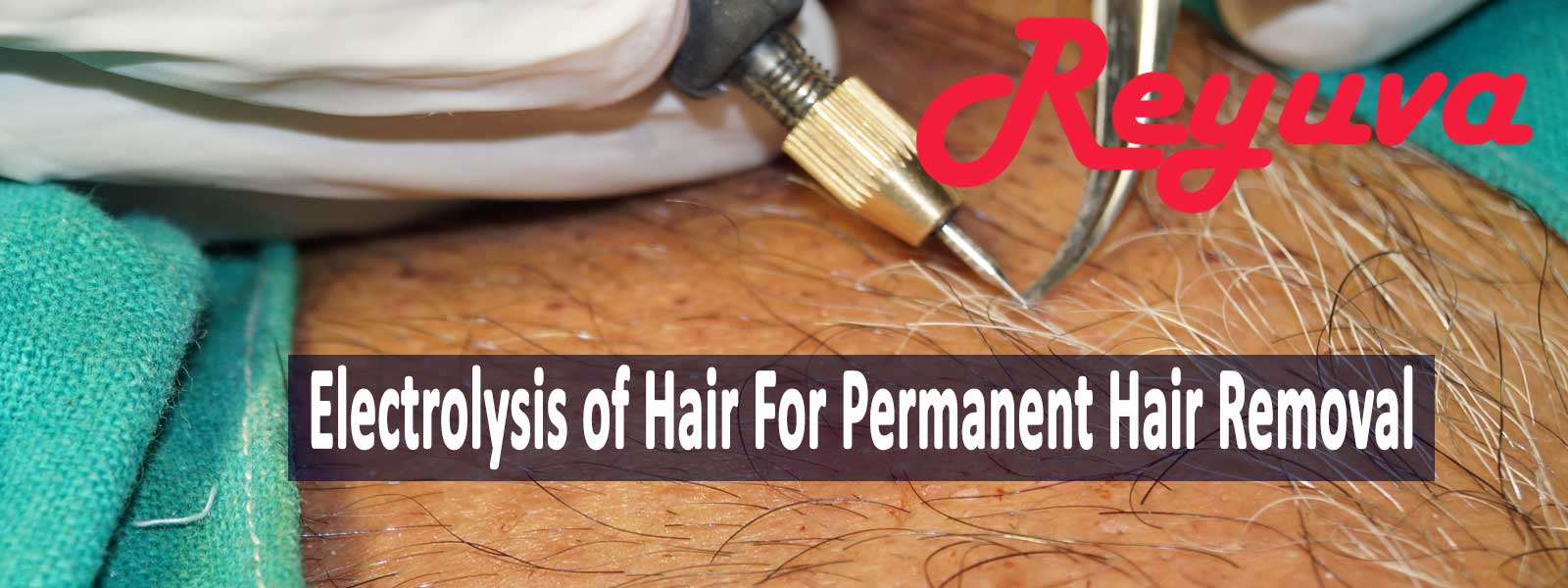Experts Guide to Electrolysis Hair Removal Treatment | Be Beautiful India
